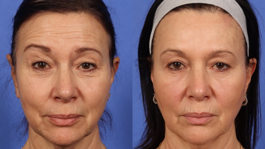 botox-before-after25